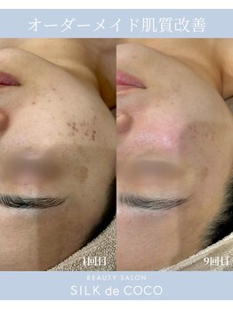 シルク ド ココ(Silk de Coco)/プラズマジェット