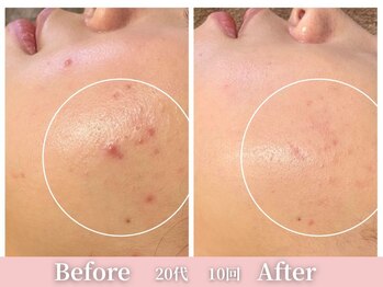 アメリイ 百合ヶ丘 新百合ヶ丘(Amerii)/ハーブピーリング/ニキビ/毛穴