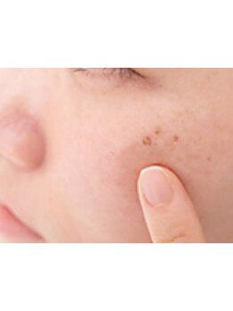 シミしわ改善！予防ケア