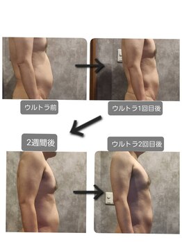 ヴィトワ(Vitowa)/ウルトランスフォーマー施術例10
