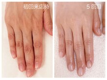 キレイテ 福岡天神店/50代/5回目【福岡ハンドケア】
