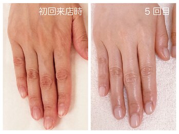 キレイテ 福岡天神店/50代/5回目【福岡ハンドケア】