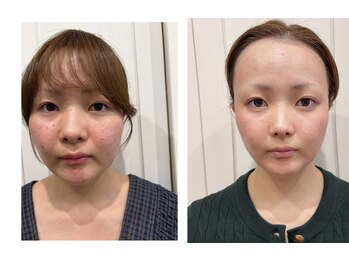 カリオンの写真/新メニュー★【極上小顔リンパリフトアップトリートメント】★フェイシャルスッキリ