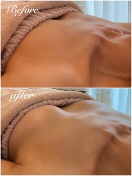 美バストアルファ(美bust α)/【バストアップ】症例