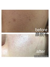 ゲッカ(GEKKA)/レディース顔脱毛