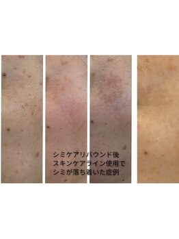 ジオリッチシフォン(giorich chiffon)/シミケアリバウンド後の改善例