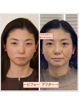 ビューティーパンク 黒田鍼治療院(Beauty Punc)/赤ら顔への