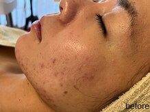 サロン ド エメ(salon de aimer)/【Before】赤み、ニキビケアに！