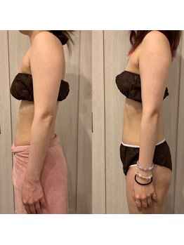 エステサロン ロティオン/人気急上昇!脂肪冷却 2カップ