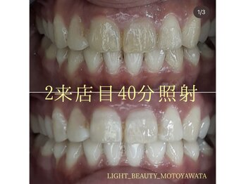 ライトビューティー 本八幡店(LIGHT BEAUTY)/【セルフホワイトニング】