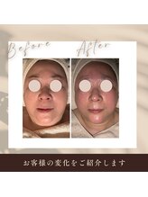 ボディケアサロン アイリフ(airef)/ピーリング＆エクソソーム4回