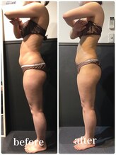 ピーラトゥ 日立(P-Ratu)/脂肪冷却◆