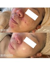 フレイヤビューティー スハダラボ 恵比寿(Freyia Beauty Suhada LABO)/ハーブピーリング
