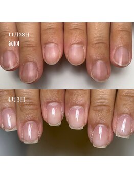 ロイヤル ネイルサロン(Royal nail Saloon)/6ヶ月の変化　自爪育成
