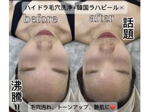 ラ ミュエル(La miel)/ハイドラ毛穴洗浄＋ラハピール