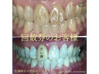 ライトビューティー 本八幡店(LIGHT BEAUTY)/【セルフホワイトニング】