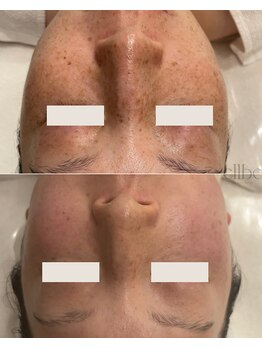 エルベ(ellbe)/肌質改善【シミケア】