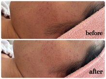 シルク(Cilk)/毛穴洗浄＋ハーブピーリング