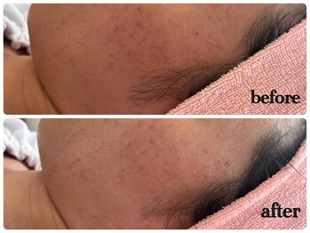 シルク(Cilk)/毛穴洗浄＋ハーブピーリング