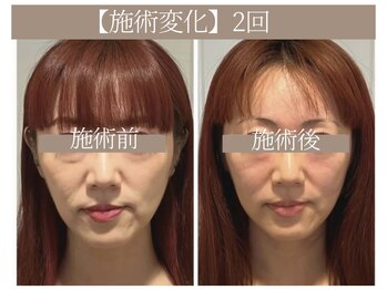 ドクターボディ 恵比寿店(Dr.Body)/【目の下のたるみ/左右差 40代】