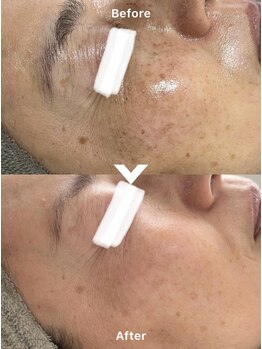 アレイズ(ARAYS)/症例