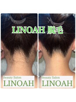 ビューティーサロン リノア(LINOAH)/◎結果重視◎【うなじ脱毛】