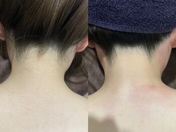 エレナビューティー(Elena Beauty)/うなじW脱毛