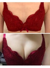 リール 新宿店(RIRE)/30代前半　バストアップ症例