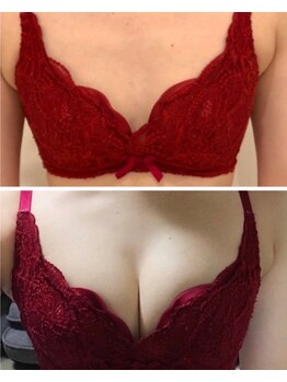 リール 新宿店(RIRE)/30代前半 バストアップ症例