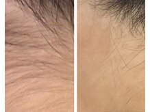 CDF 赤坂/全身脱毛３回目初回￥8800