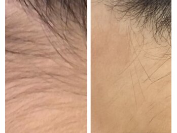 CDF 赤坂/全身脱毛３回目初回￥8800