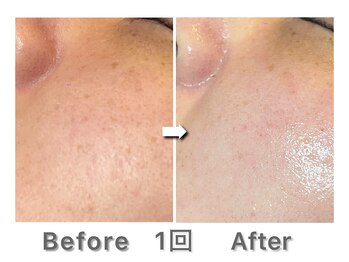 ナルシス/【ハーブピーリング】1回の変化