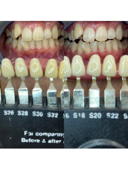 トウキョースワーズ 渋谷店(TOKYO SWRS)/#ホワイトニング #渋谷 #池袋