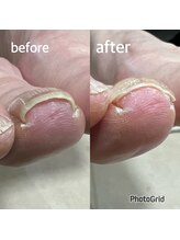 北区天神橋巻き爪センター/巻き爪