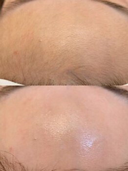 ルクール(Le Coeur)の写真/【WAX脱毛×光脱毛】のMIX脱毛で気になる産毛までスッキリ♪効果を即実感できる◎つるんとたまご肌に！