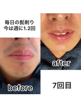 オアシス カナヤマ(Oasis kanayama)/【ヒゲ脱毛】ビフォーアフター★