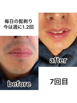 オアシス カナヤマ(Oasis kanayama)/【ヒゲ脱毛】ビフォーアフター★