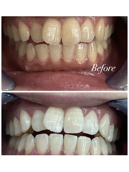 ビューティーケア(beauty care)/【ホワイトニング】