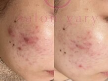 サロンヴェアリー 広尾(salon vary)/水玉リフティング5回施術#敏感肌
