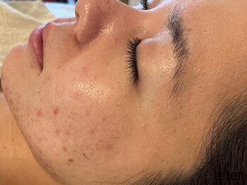 サロン ド エメ(salon de aimer)/【After】赤み改善、ニキビケア