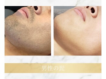 アンド エヌ(&n)/◆髭脱毛◆