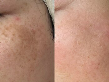 プレナ(PLENA)/“本当に変わりました”40代女性