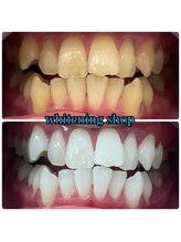 ホワイトニングショップ 鳳店/BeforeAfter 美白ホワイトニング
