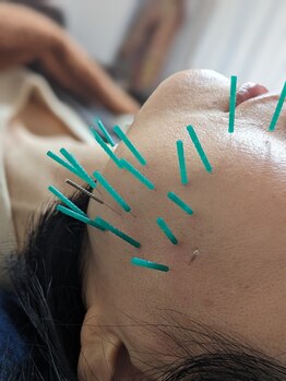 乃々鍼灸整体院 表参道/美容鍼