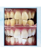 エクシアホワイトニング 塩釜口駅前店/３０代半ば男性の効果事例