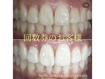 ライトビューティー 本八幡店(LIGHT BEAUTY)/セルフホワイトニングで素敵な歯