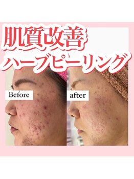 ホワイトアクア 四日市店(WHITE AQUA)/肌改善/ハーブピーリング/陶器肌