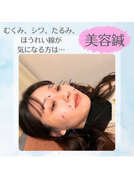 サンライズ鍼灸整骨院 石橋院/美容鍼