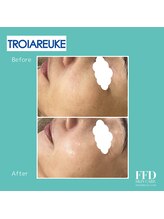 エフエフディースキンケア(FFD SKINCARE)/ピーリング症例