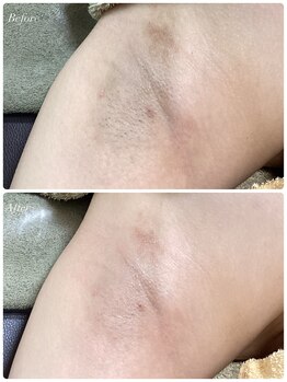 シャナ(Shana)/カーボキシーボディ(脇)